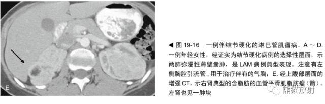 肺淋巴管肌瘤病(LAM)的诊断与鉴别诊断 肺淋巴管肌瘤病(LAM)的诊断与鉴别诊断