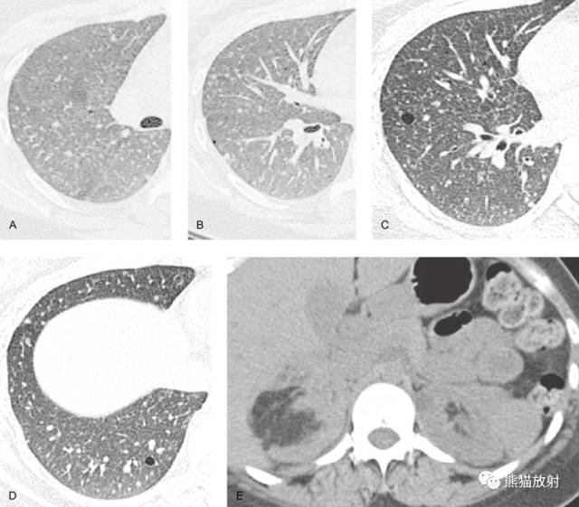 肺淋巴管肌瘤病(LAM)的诊断与鉴别诊断 肺淋巴管肌瘤病(LAM)的诊断与鉴别诊断