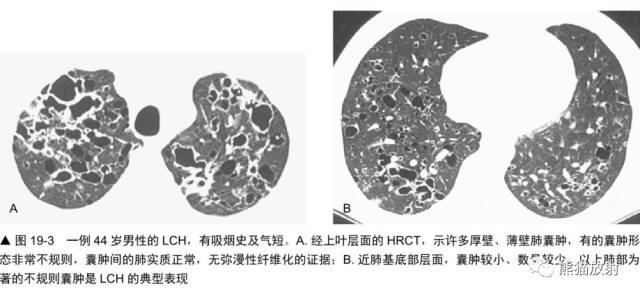 肺淋巴管肌瘤病(LAM)的诊断与鉴别诊断 肺淋巴管肌瘤病(LAM)的诊断与鉴别诊断