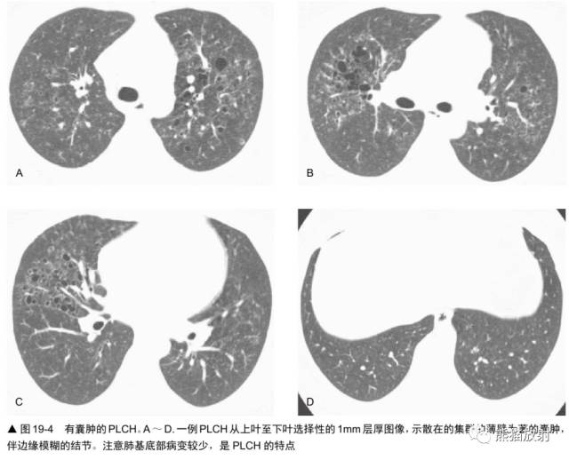 肺淋巴管肌瘤病(LAM)的诊断与鉴别诊断 肺淋巴管肌瘤病(LAM)的诊断与鉴别诊断
