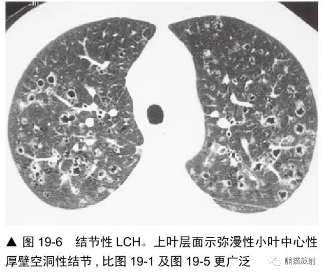 肺淋巴管肌瘤病(LAM)的诊断与鉴别诊断 肺淋巴管肌瘤病(LAM)的诊断与鉴别诊断