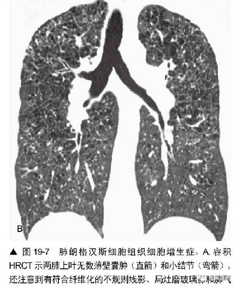 肺淋巴管肌瘤病(LAM)的诊断与鉴别诊断 肺淋巴管肌瘤病(LAM)的诊断与鉴别诊断