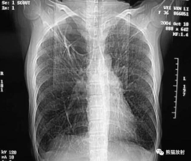 【病例】肺淋巴管肌瘤病PLAM合并左肾血管平滑肌脂肪瘤AML一例 【病例】肺淋巴管肌瘤病PLAM合并左肾血管平滑肌脂肪瘤AML一例