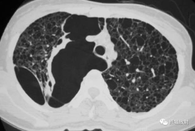 【病例】肺淋巴管肌瘤病PLAM合并左肾血管平滑肌脂肪瘤AML一例 【病例】肺淋巴管肌瘤病PLAM合并左肾血管平滑肌脂肪瘤AML一例