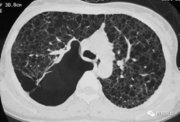 【病例】肺淋巴管肌瘤病PLAM合并左肾血管平滑肌脂肪瘤AML一例 【病例】肺淋巴管肌瘤病PLAM合并左肾血管平滑肌脂肪瘤AML一例