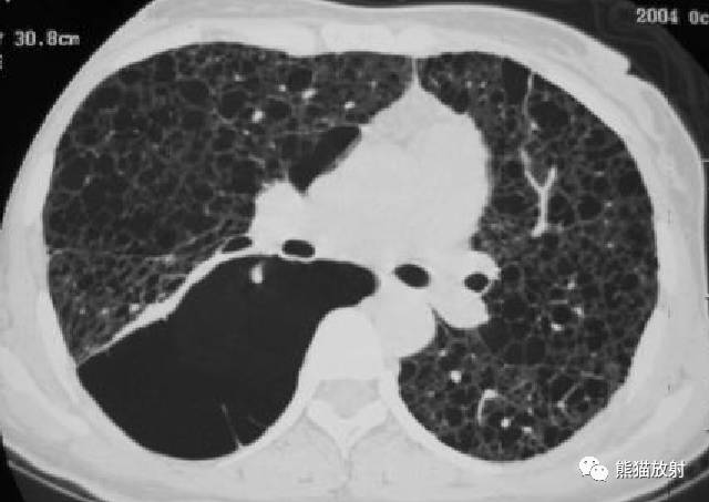 【病例】肺淋巴管肌瘤病PLAM合并左肾血管平滑肌脂肪瘤AML一例 【病例】肺淋巴管肌瘤病PLAM合并左肾血管平滑肌脂肪瘤AML一例