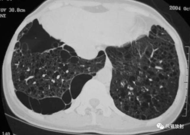 【病例】肺淋巴管肌瘤病PLAM合并左肾血管平滑肌脂肪瘤AML一例 【病例】肺淋巴管肌瘤病PLAM合并左肾血管平滑肌脂肪瘤AML一例