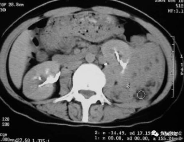 【病例】肺淋巴管肌瘤病PLAM合并左肾血管平滑肌脂肪瘤AML一例 【病例】肺淋巴管肌瘤病PLAM合并左肾血管平滑肌脂肪瘤AML一例