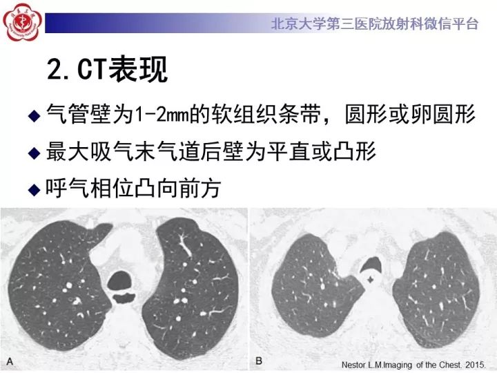 【PPT】气管的正常CT表现及疾病