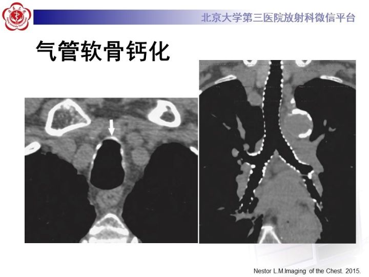 【PPT】气管的正常CT表现及疾病