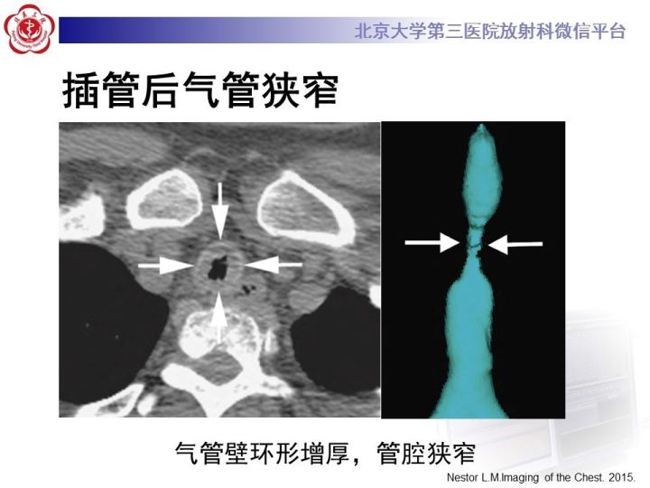 【PPT】气管的正常CT表现及疾病