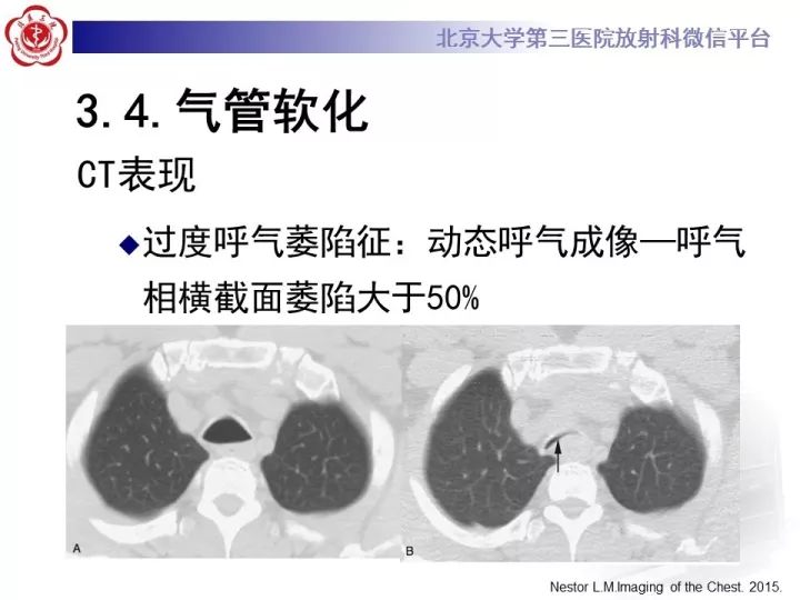 【PPT】气管的正常CT表现及疾病