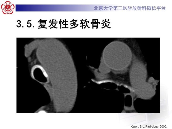 【PPT】气管的正常CT表现及疾病