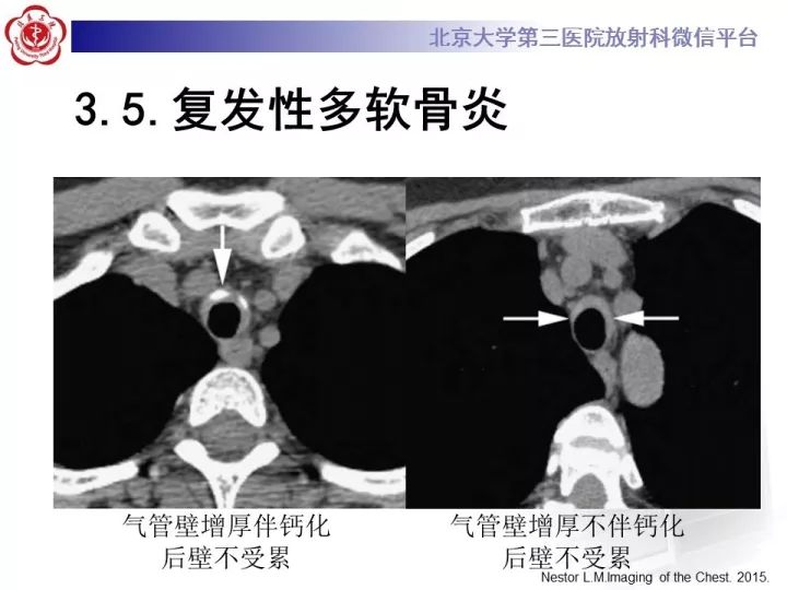 【PPT】气管的正常CT表现及疾病