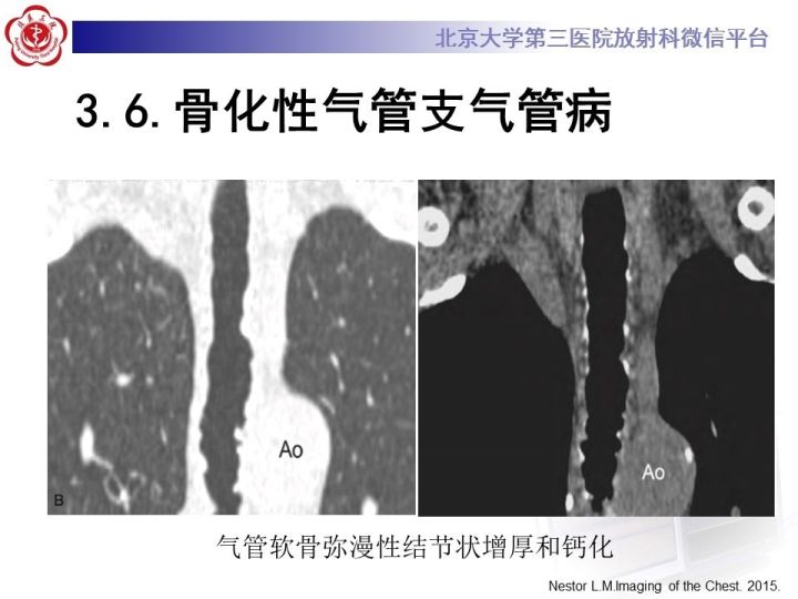 【PPT】气管的正常CT表现及疾病