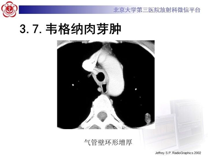 【PPT】气管的正常CT表现及疾病