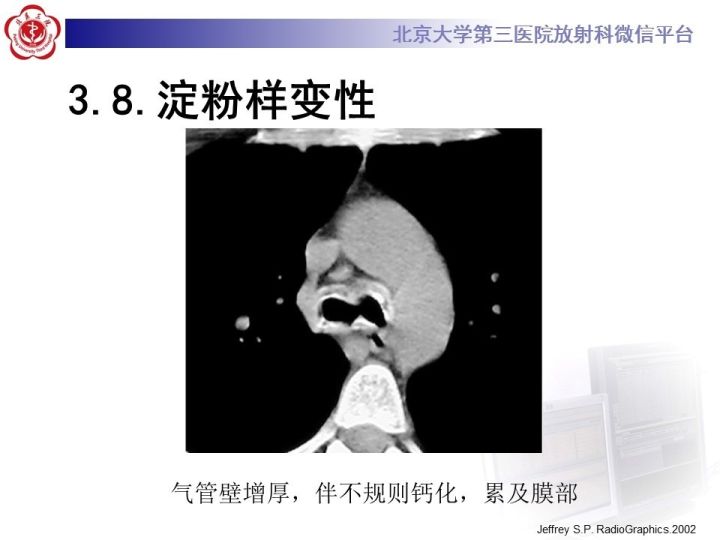 【PPT】气管的正常CT表现及疾病