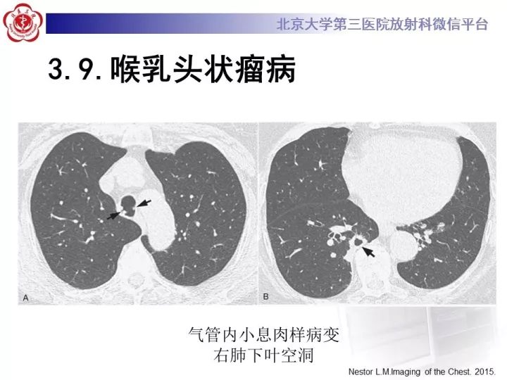 【PPT】气管的正常CT表现及疾病