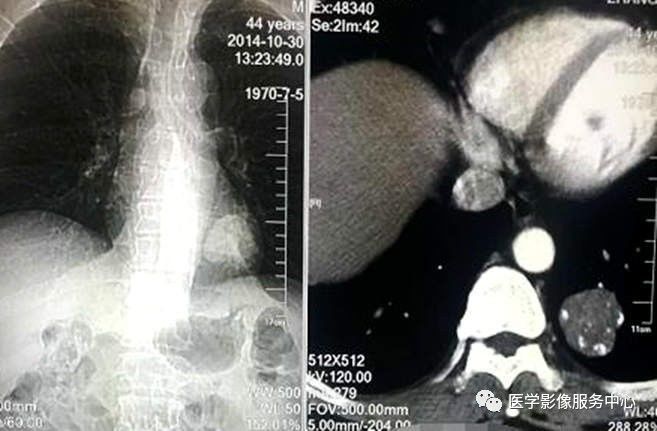 【病例】左肺下叶错构瘤1例CT