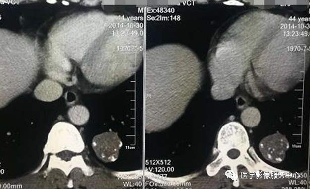 【病例】左肺下叶错构瘤1例CT