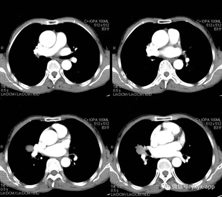 【病例】右肺中叶硬化性血管瘤1例CT