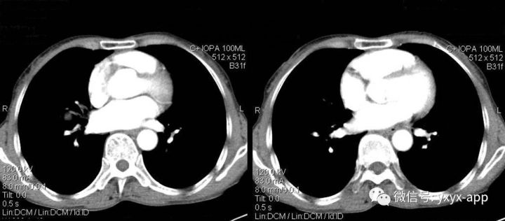 【病例】右肺中叶硬化性血管瘤1例CT