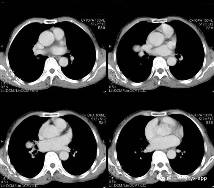 【病例】右肺中叶硬化性血管瘤1例CT
