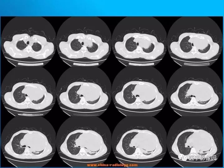 【病例】纵隔恶性神经鞘瘤1例CT 【病例】纵隔恶性神经鞘瘤1例CT