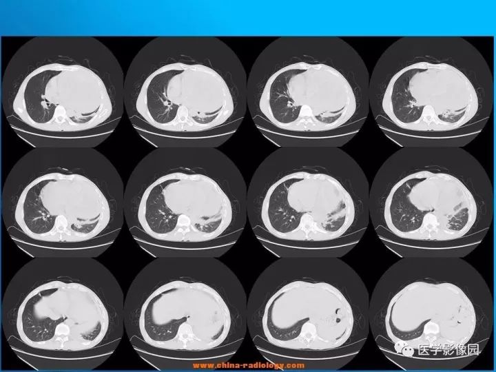 【病例】纵隔恶性神经鞘瘤1例CT 【病例】纵隔恶性神经鞘瘤1例CT