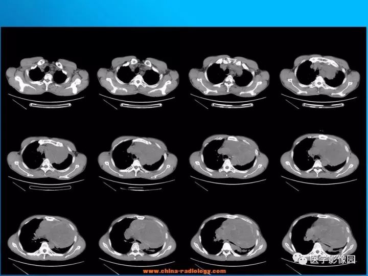 【病例】纵隔恶性神经鞘瘤1例CT 【病例】纵隔恶性神经鞘瘤1例CT