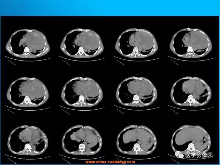 【病例】纵隔恶性神经鞘瘤1例CT 【病例】纵隔恶性神经鞘瘤1例CT