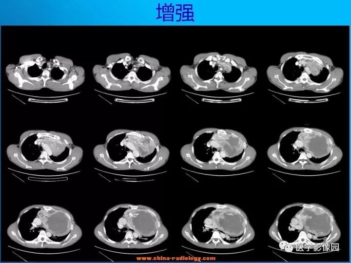 【病例】纵隔恶性神经鞘瘤1例CT 【病例】纵隔恶性神经鞘瘤1例CT