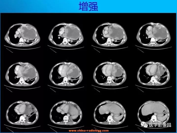 【病例】纵隔恶性神经鞘瘤1例CT 【病例】纵隔恶性神经鞘瘤1例CT