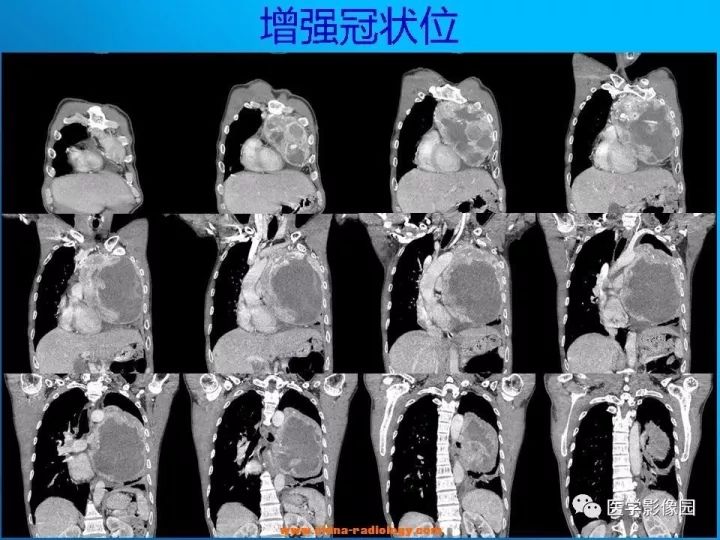 【病例】纵隔恶性神经鞘瘤1例CT 【病例】纵隔恶性神经鞘瘤1例CT