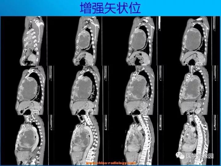 【病例】纵隔恶性神经鞘瘤1例CT 【病例】纵隔恶性神经鞘瘤1例CT