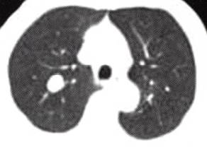 【病例】肺错构瘤1例CT影像表现 【病例】肺错构瘤1例CT影像表现