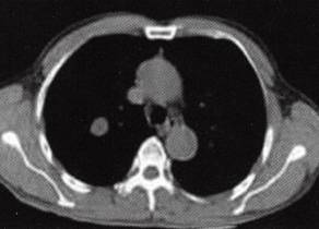 【病例】肺错构瘤1例CT影像表现 【病例】肺错构瘤1例CT影像表现