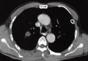 【病例】肺错构瘤1例CT影像表现 【病例】肺错构瘤1例CT影像表现