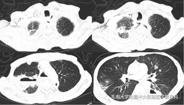 【病例】食道纵隔胸膜瘘1例CT
