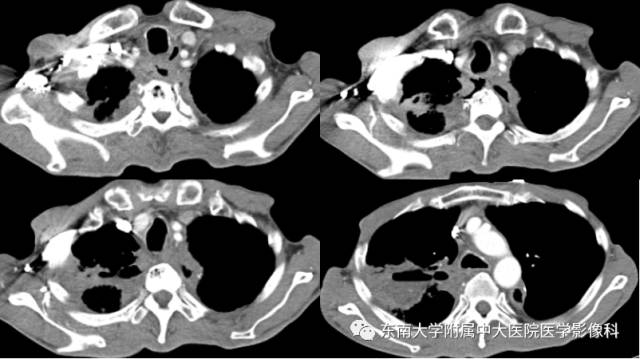 【病例】食道纵隔胸膜瘘1例CT