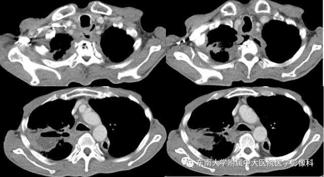 【病例】食道纵隔胸膜瘘1例CT