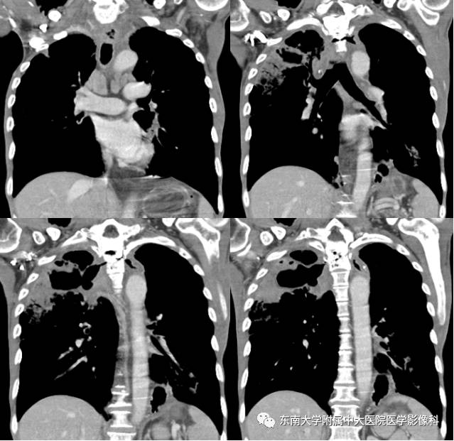 【病例】食道纵隔胸膜瘘1例CT