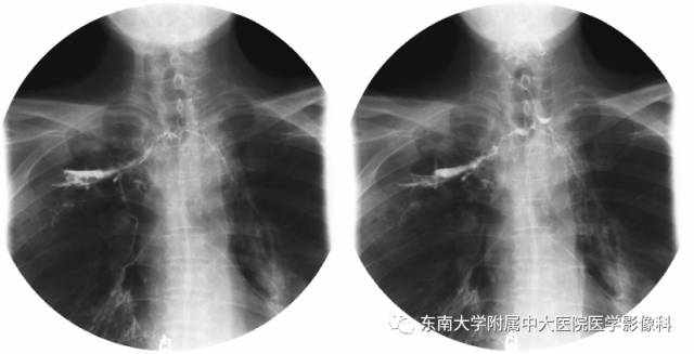 【病例】食道纵隔胸膜瘘1例CT