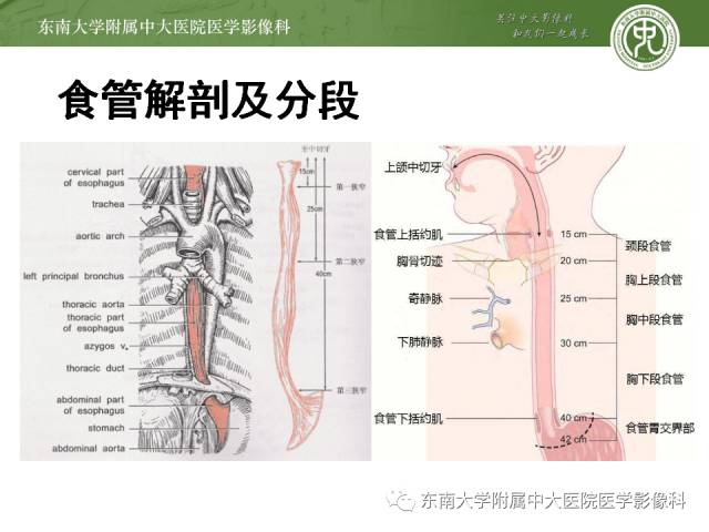 【病例】食道纵隔胸膜瘘1例CT