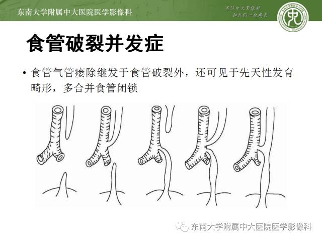 【病例】食道纵隔胸膜瘘1例CT