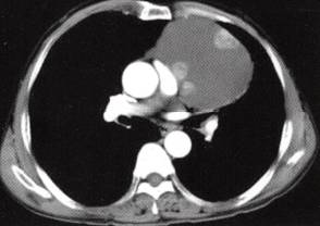 【病例】胸腺囊肿1例CT
