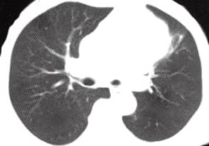 【病例】胸腺囊肿1例CT