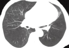 【病例】胸腺囊肿1例CT
