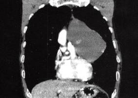 【病例】胸腺囊肿1例CT