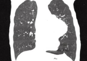 【病例】胸腺囊肿1例CT